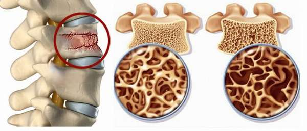 Остеосклероз в теле подвздошной кости